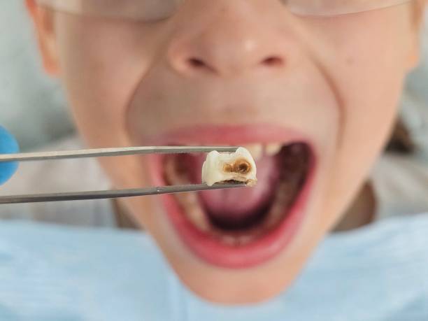 Best Emergency Root Canal Treatment in Millen, GA